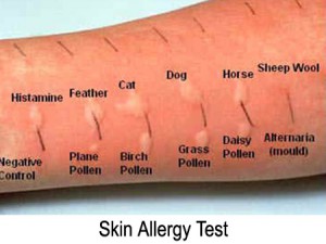 skin-allergy-test